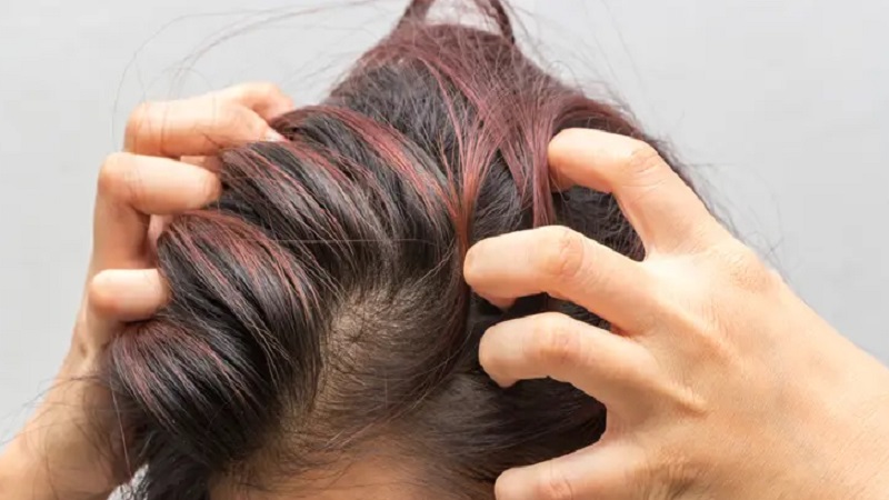 গরমে মাথার ত্বকের জ্বালাপোড়া ও চুলকানি রোধের ঘরোয়া উপায়