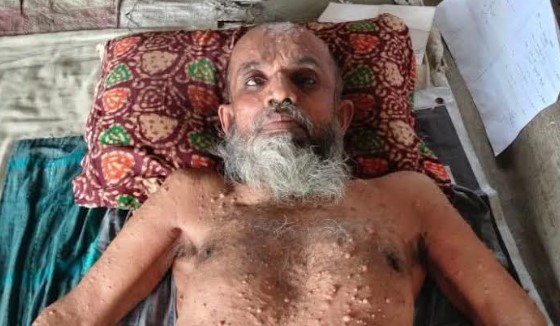 ছয় বছর ধরে বারান্দায় পড়ে আছেন পাইকগাছার লতিফ, মিলছে না চিকিৎসা